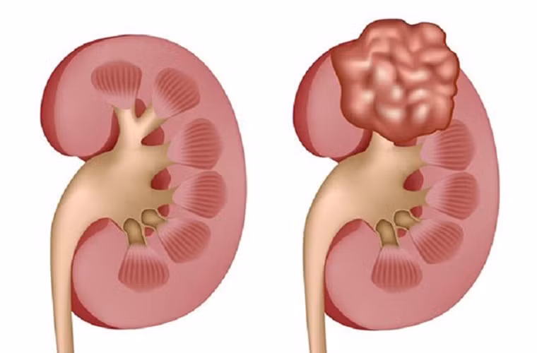  Khối u Wilms. Khối u Wilms là một dạng ung thư thận hiếm, chủ yếu ảnh hưởng ở trẻ em. Bệnh thường được chẩn đoán ở trẻ em từ 3 – 4 tuổi. 