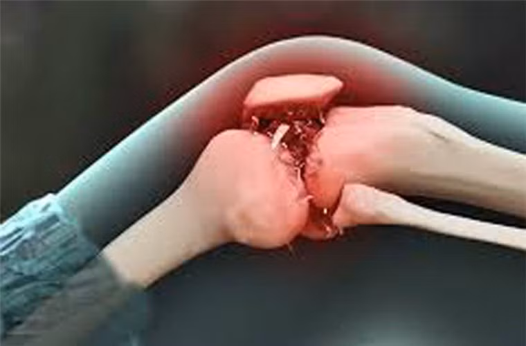  Xuất hiện khối u. Ban đầu, khối u có thể là một đám chắc, đẩy gồ mặt da, bờ không rõ, sờ nắn không đau. Về sau to nhanh, làm biến dạng vùng có u. U thâm nhiễm tổ chức phần mềm, nổi rõ các mạch máu dưới da và tân tạo các mạch máu nhỏ, đau khi thăm khám, màu sắc da trở nên hồng, ấm hơn nơi khác, mật độ nơi mềm, nơi chắc, nơi căng do máu tụ. 