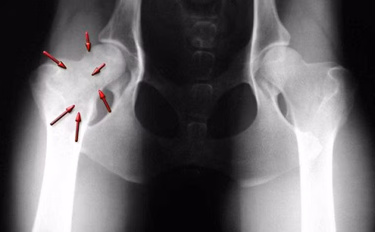  Một trong những dấu hiệu thường gặp nhất ở bệnh nhân là tình trạng đau, sưng ở chân, cánh tay. Cảm giác đau thường xuất hiện ở các vị trí xương dài như trên hoặc dưới đầu gối, cánh tay hoặc trên vai. 