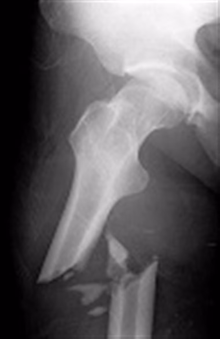  Gãy xương. Khi các tế bào ung thư phát triển trong khu vực này, nó tác động làm suy yếu xương. Ngay cả những tác động nhỏ, bất ngờ cũng khiến bệnh nhân đối diện với tình trạng gãy xương. Thậm chí, một số trường hợp khi nhập viện, các bác sĩ vẫn có thể nhầm lẫn bệnh với nguyên nhân gãy xương thông thường, tiến hành bó bột hoặc đóng đinh nội tủy. 