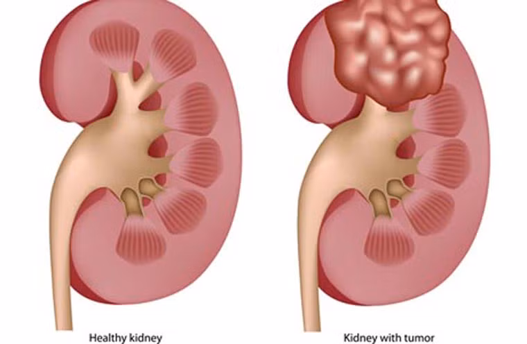  Ung thư thận. Ung thư thận phổ biến ở trẻ trong độ tuổi từ 3- 4 tuổi hoặc sớm hơn. Bệnh thường có triệu chứng to bụng, đặt bàn tay vào hố thắt lưng có cảm giác như một khối to đè lên bàn tay. Khối u có dạng hình tròn, chắc. Ngoài ra, người bệnh có thể có triệu chứng tiểu ra máu, tăng huyết áp, viêm đường tiết niệu, giãn tĩnh mạch thừng tinh. 