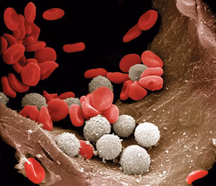  Ung thư bạch cầu còn được biết đến với tên gọi ung thư máu. Dạng phổ biến nhất của ung thư bạch cầu là lymphocytic cấp tính (ALL) và bạch cầu nguyên bào tuỷ cấp (AML). Bệnh gây nên chứng mệt mỏi, suy nhược, da xanh xao, chảy máu, dễ bầm tím, sốt và sụt cân bất thường. 