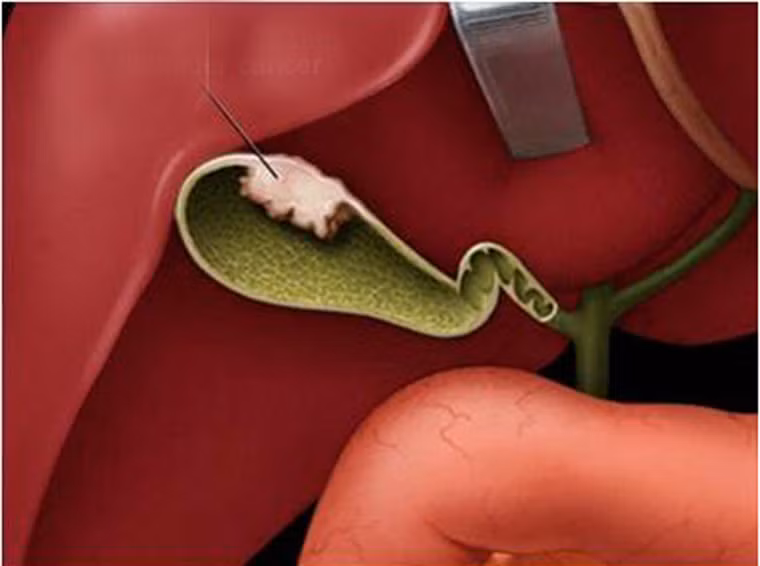  Để kiểm chứng, các nhà khoa học từng nghiên cứu dữ liệu từ hơn 60.000 bệnh nhân duy trì chế độ ăn uống có sử dụng quả óc chó trong suốt 10 năm. Kết quả cho thấy, óc chó có khả năng ngừa sỏi túi mật cực nhạy. 