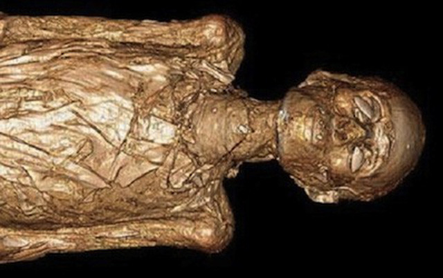 Can benh kinh khung tren xac uop Ai Cap co dai