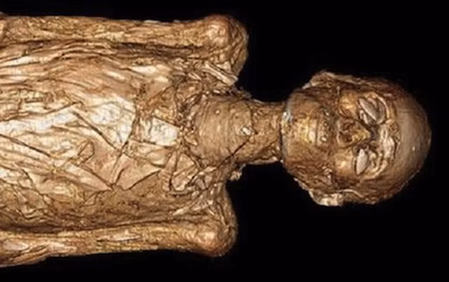 Can benh kinh khung tren xac uop Ai Cap co dai