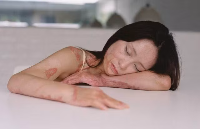 Những bức ảnh của Zhou đã thu hút được 45.000 lượt thích và 18.000 lượt bình luận. Nhiều cư dân mạng tỏ ra khâm phục sự can đảm và kiên trì của cô gái. Trong khi đó, những người khác đã nguyền rủa kẻ gây ra những vết sẹo trên cơ thể cô.