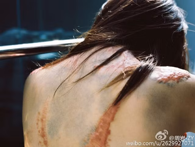 Ngay sau khi sự việc xảy ra, bố của Tao là một quan chức chính quyền địa phương đã công khai xin lỗi Zhou trên mạng xã hội Weibo. Ông ta nói sẽ làm tất cả những gì có thể để giúp đỡ cô hồi phục tốt nhất.