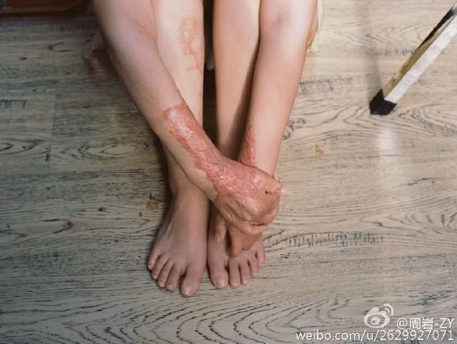 Vào năm 2011, Zhou Yan, lúc đó mới 17 tuổi, đã bị bạn trai cùng lớp tên Tao Rukun phóng hỏa, sau khi cô từ chối lời tỏ tình của cậu ta.