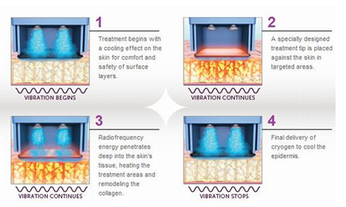 Cơ chế tác động của công nghệ Thermage.