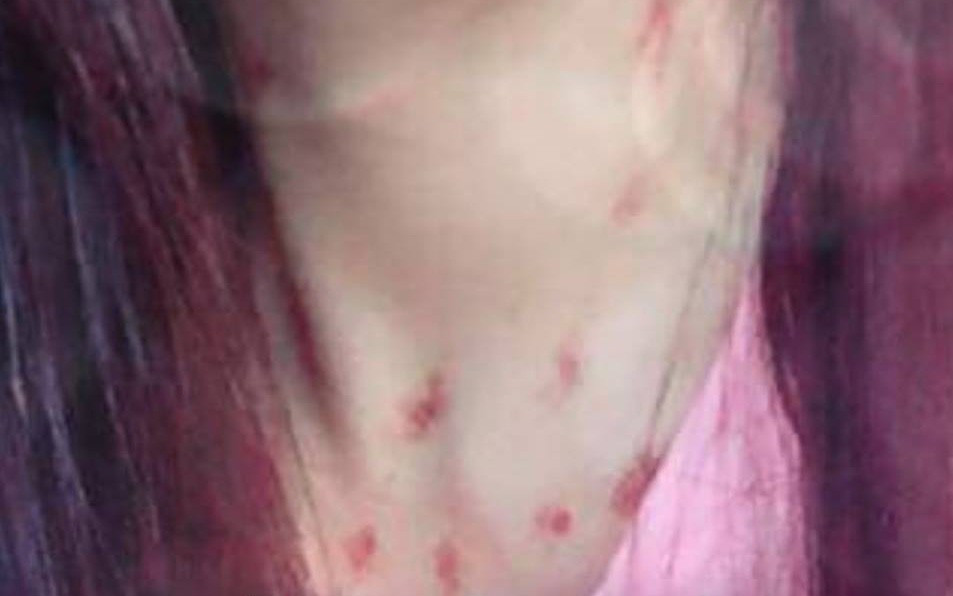 Chàng trai biết mình có rổ sừng nhờ dân mạng soi vết lạ trên cổ bạn gái Chang trai biet minh co ro sung nho dan mang soi vet la tren co ban gai