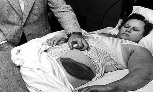 Bà Ann Elizabeth Hodges (1923 - 1972), người duy nhất thế giới bị thiên thạch đập trúng ngay trong ngôi nhà thuê ở Sylacauga, tiểu bang Alabama (Mỹ) vào cuối năm 1954.
