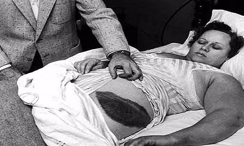 Bà Ann Elizabeth Hodges (1923 - 1972), người duy nhất thế giới bị thiên thạch đập trúng ngay trong ngôi nhà thuê ở Sylacauga, tiểu bang Alabama (Mỹ) vào cuối năm 1954.