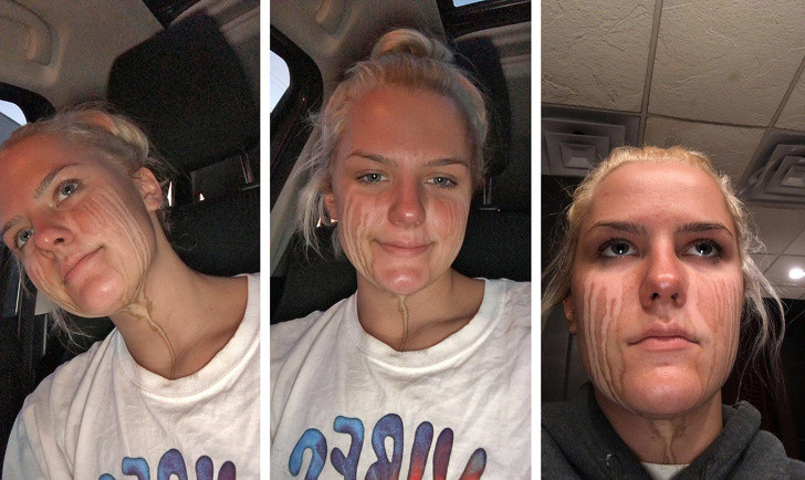 Những vệt loang lở chảy dài trên mặt cô gái xịt dung dịch nhuộm da nhân tạo để làm đẹp.