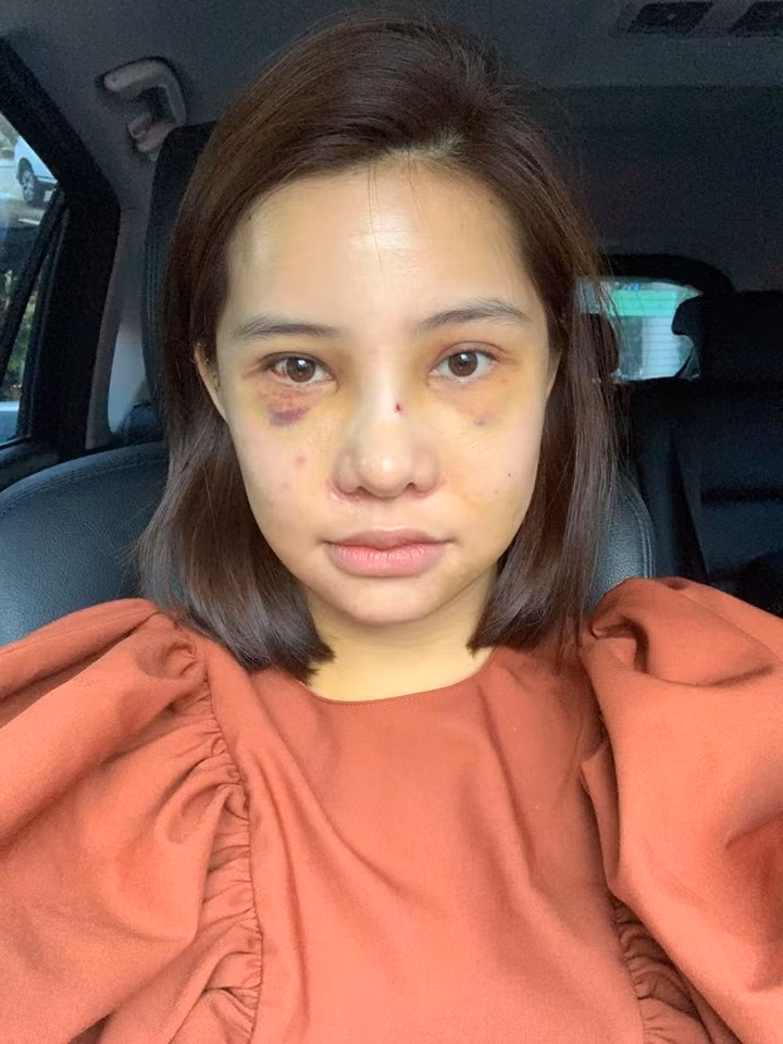 Sau 1 tuần phẫu thuật, Lưu Đê Ly đã bỏ hết băng trên mặt nhưng mặt vẫn có chỗ sưng và thâm tím.