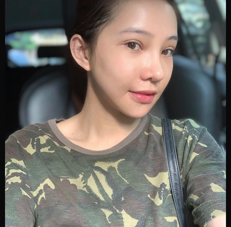 Sau 1 tháng vẫn có thể nhận ra Lưu Đê Ly phẫu thuật thẩm mỹ với sẹo nhỏ trên cánh mũi.