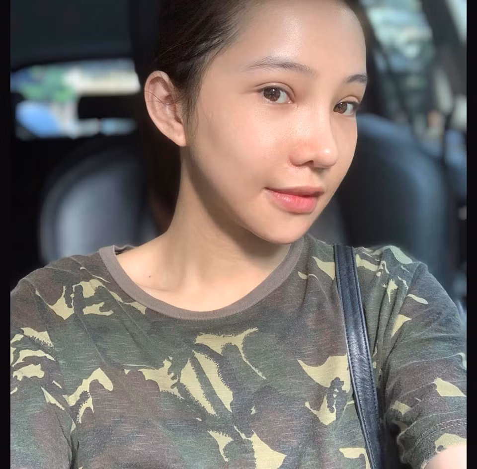 Sau 1 tháng vẫn có thể nhận ra Lưu Đê Ly phẫu thuật thẩm mỹ với sẹo nhỏ trên cánh mũi.