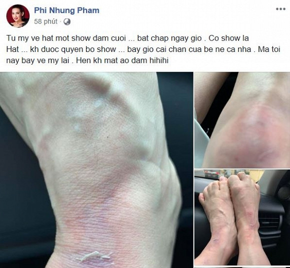 Trong hình, phần cổ chân và đầu gối của giọng ca "Chiều lên bản thượng" bị trầy xước, sưng tấy.