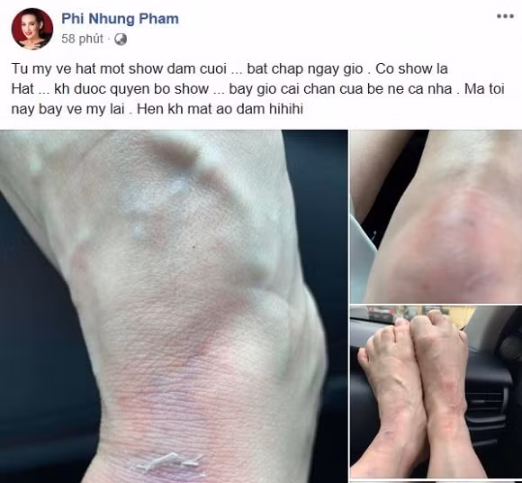 Trong hình, phần cổ chân và đầu gối của giọng ca "Chiều lên bản thượng" bị trầy xước, sưng tấy.