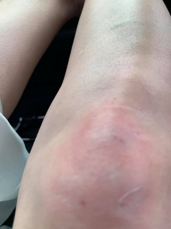 Nhìn ảnh này, người hâm mộ Phi Nhung lo lắng: "Hai ơi! Hai giữ sức khỏe nhé", "Trời nhìn đau quá em ơi", "Thương em chân như vậy tối em lại đi tiếp rồi", "Ngã hay sao mà nặng quá vầy nè. Bầm tím hết vậy chị Hai", "Chị cố gắng nghỉ ngơi nhé chị, đau lắm",...