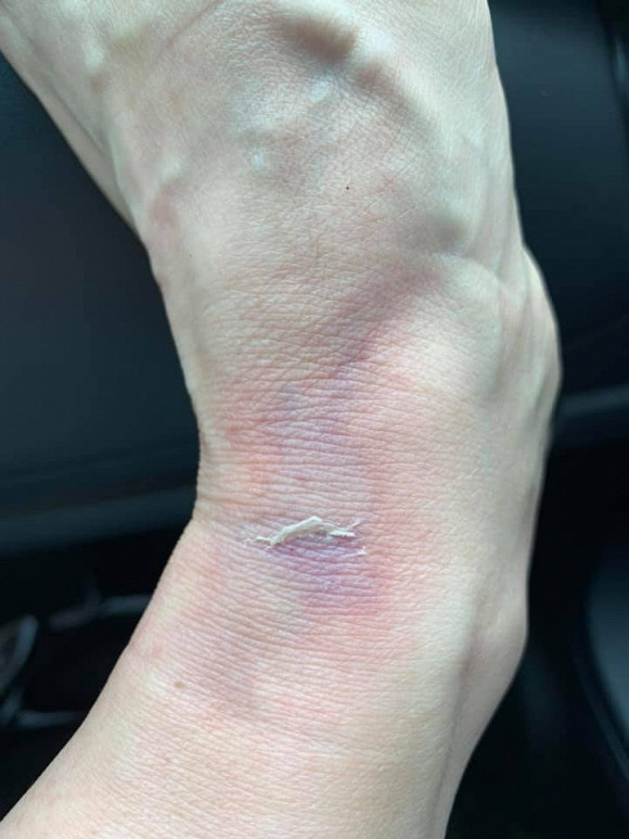 Hình ảnh Phi Nhung bị ngã bầm tím chân.