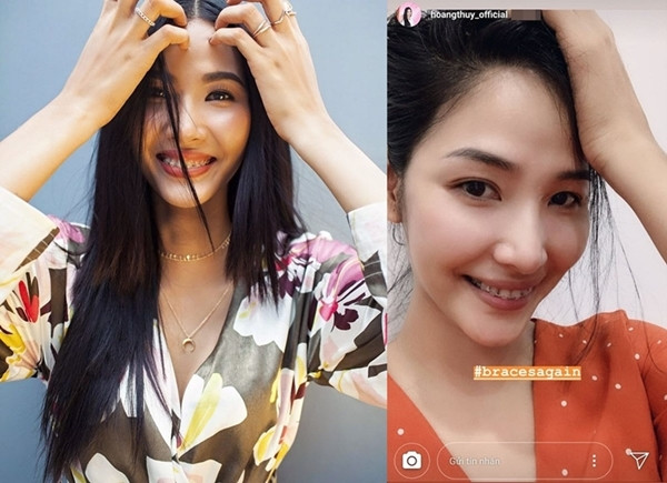 Sau quá trình niềng răng, Á hậu Hoàng Thùy đã tự tin khoe nụ cười rạng rỡ trên trang cá nhân. Nụ cười rạng ngời, khoe răng đều tăm tắp đầy tự tin sẽ là “vũ khí” lợi hại giúp Hoàng Thùy ghi điểm trước ban giám khảo Cuộc thi Hoa hậu Hoàn vũ Thế giới 2019. Những thay đổi tích cực từ cả vóc dáng đến “chuẩn chỉnh răng xinh”, cộng đồng fan sắc đẹp càng đặt niềm tin lớn vào đại diện Việt Nam tại đấu trường nhan sắc nóng bỏng nhất hành tinh năm nay.
