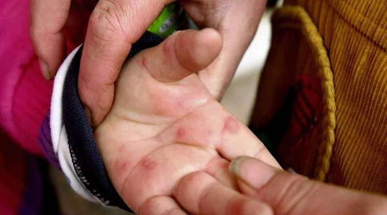 Virus “cum ca chua” lay nhanh o tre em nguy hiem sao?