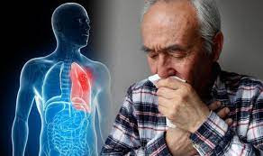 Cally Palmer, giám đốc quốc gia về ung thư của NHS Anh, cho biết: "Thực tế, hầu hết những người được chẩn đoán sớm mắc bệnh ung thư phổi đều sống sót. Vì vậy, mọi người cần phải nhận thức được các triệu chứng và điều trị càng sớm càng tốt". Ảnh: DE.