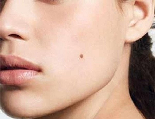 4 nốt ruồi "thu hút của cải", ai sở hữu thì bạc vàng đầy tay 4 not ruoi