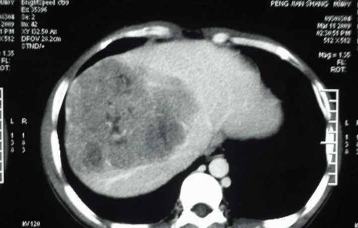 Sau nhiều lần kiểm tra tại bệnh viện, bác sĩ phát hiện ra rằng alpha-fetoprotein trong cơ thể của cô Vương Khiết vượt quá tiêu chuẩn nghiêm trọng, chẩn đoán là ung thư gan giai đoạn giữa, phải nhập viện ngay lập tức.