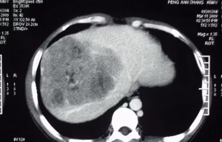 Sau nhiều lần kiểm tra tại bệnh viện, bác sĩ phát hiện ra rằng alpha-fetoprotein trong cơ thể của cô Vương Khiết vượt quá tiêu chuẩn nghiêm trọng, chẩn đoán là ung thư gan giai đoạn giữa, phải nhập viện ngay lập tức.