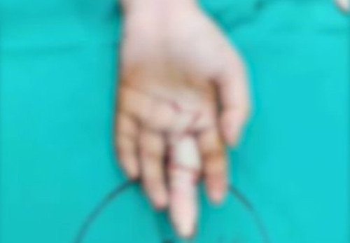 Nhan qua chat, co gai lam dieu nay khien ngon tay chi con...xuong trang