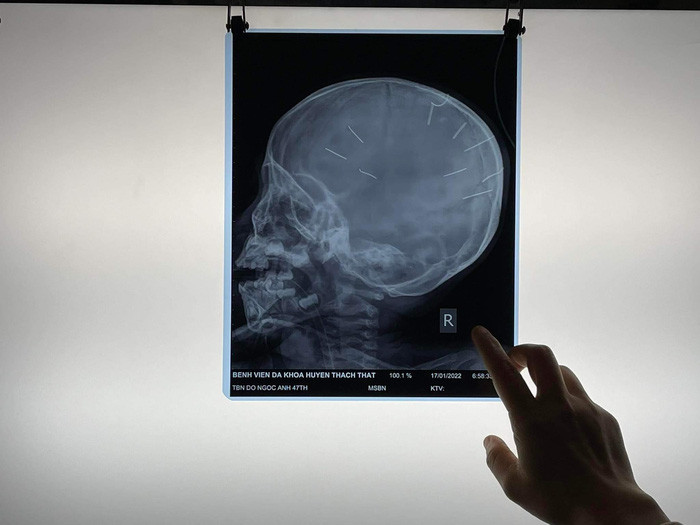 Hình ảnh chụp X-quang của bé gái với 9 đinh ghim vào đầu.