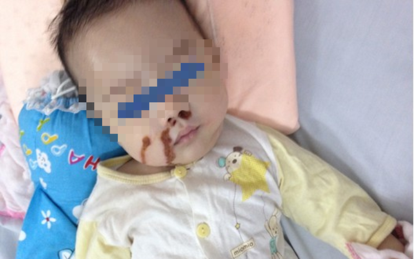 Chau be bong nang vi me nho nham axit vao mui