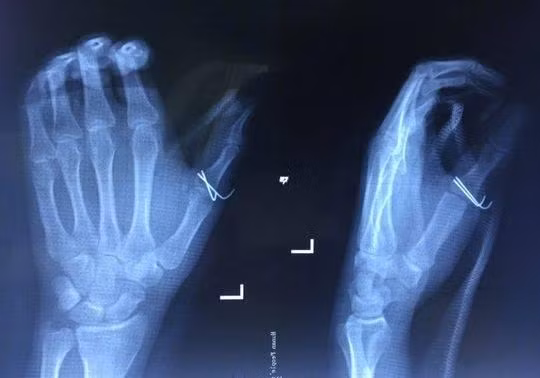 Chuyen la hom nay: Lam viec kho tin, chang trai suyt mat ca ban tay-Hinh-4