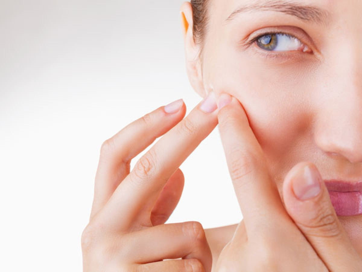  Nặn mụn: Thói quen chăm sóc da sai lầm cũng có thể là nguyên nhân làm lỗ chân lông to ra. Nặn mụn, thường xuyên chạm tay lên mặt hoặc trị mụn đầu đen sai cách có thể khiến lỗ chân lông to ra mà không thể khắc phục.