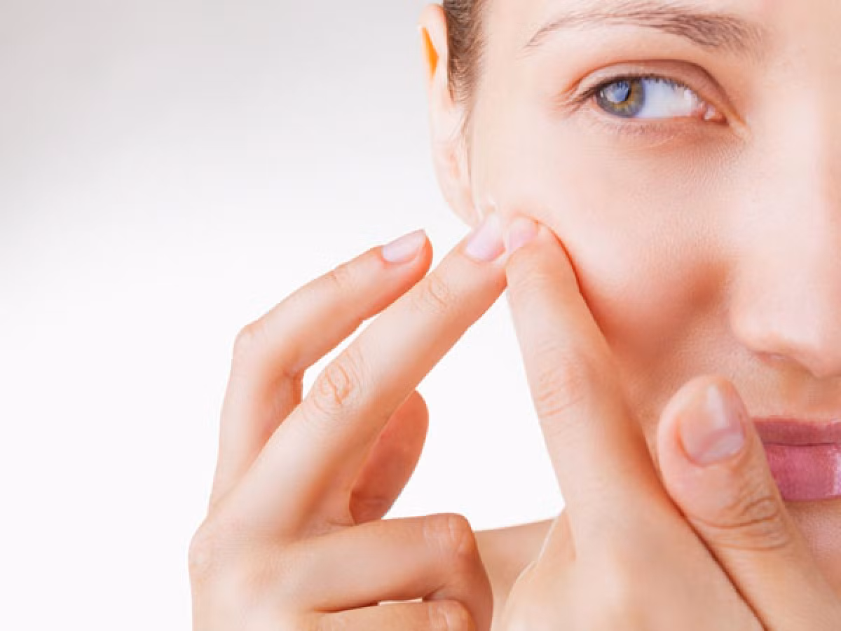  Nặn mụn: Thói quen chăm sóc da sai lầm cũng có thể là nguyên nhân làm lỗ chân lông to ra. Nặn mụn, thường xuyên chạm tay lên mặt hoặc trị mụn đầu đen sai cách có thể khiến lỗ chân lông to ra mà không thể khắc phục.