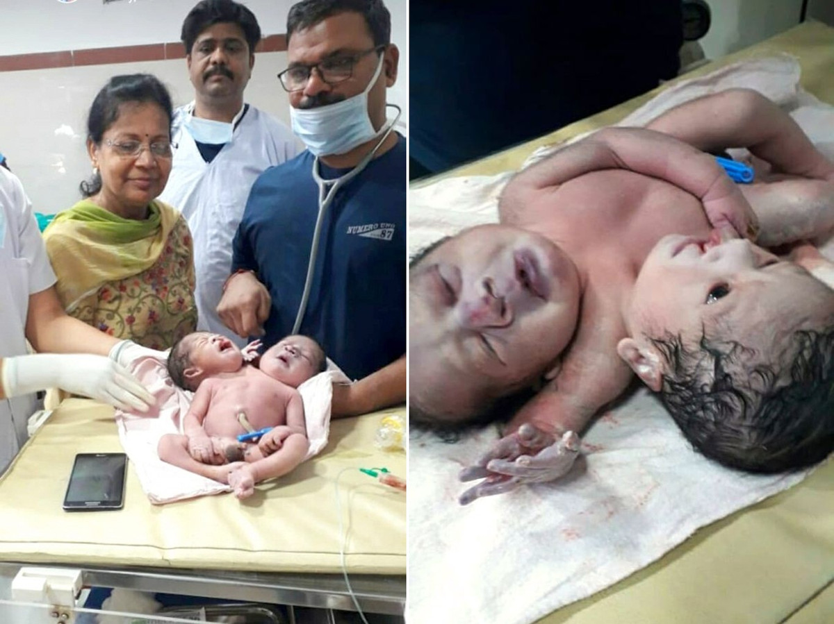 Be trai so sinh hai dau, ba tay gay xon xao