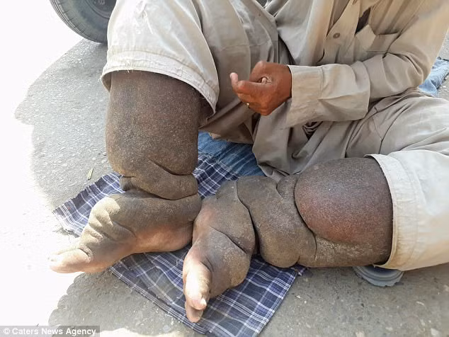 Người đàn ông có bàn chân voi này không thể đứng yên tại chỗ được vài phút và vợ ông là bà Zainab Bibi phải giúp trong các hoạt động đi lại và leo lên cầu thang trong căn nhà thuê của họ. Ảnh: CNA.