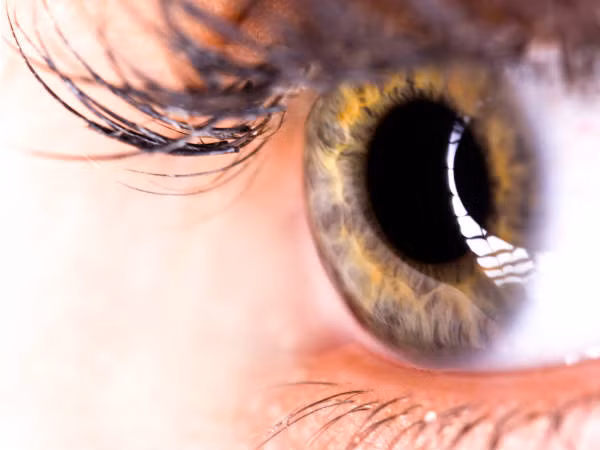 5. Không vệ sinh cẩn thận: Khử trùng kính áp tròng hàng ngày với đồ chuyên dụng để ngăn không cho mắt bị viêm là điều cần thiết. Nước rửa mắt kính áp tròng phải là nước chuyên dụng, chứ không đơn thuần là nước rửa bình thường hay lau khô vì sẽ làm tổn hại đến kính áp tròng. Ảnh: Boldsky.