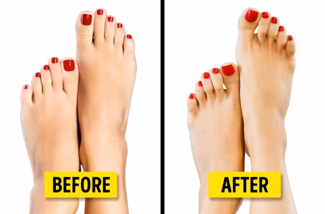 Với kỳ vọng có bàn chân đeo giày cao gót đẹp hơn, nhiều chị em đã chi không ít tiền để phẫu thuật rút ngắn ngón chân. Ảnh: Depositphotos.