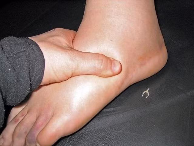 Phù nề: Tĩnh mạch chân bị giãn ra có thể làm tắc huyết khối tĩnh mạch, làm gián đoạn sự lưu chuyển của bạch huyết trong cách mạch bạch huyết. Từ đó, các hội chứng này khiến áp lực trong các mao mạch nhỏ gia tăng, chất lỏng từ huyết tương máu tiết ra sẽ đi vào các mô xung quanh. Chúng chứa nhiều muối và protein gây sưng, phù nề các cơ quan này. Ảnh: Anamariabianchini.