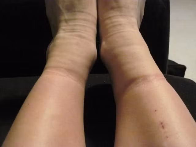 Tăng nguy cơ giãn tĩnh mạch: Giãn tĩnh mạch, còn được gọi là bệnh suy giãn tĩnh mạch chi dưới mạn tính, là hiện tượng các tĩnh mạch phình ra, nổi lên rõ ràng trên gần bề mặt da. Mang tất chân quá chật cũng là nguyên nhân dẫn tới giãn tĩnh mạch. Người bị giãn tính mạch mãn tính do mang tất chật trong một thời gian dài sẽ làm cho tình trạng trầm trọng hơn. Ảnh: Tnypic.