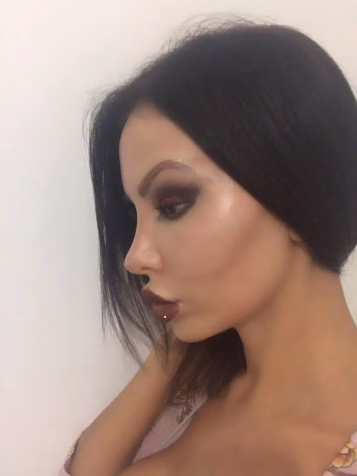 Tổng cộng, cô đã chi tới 200.000 bảng (khoảng 6 tỷ đồng) cho việc phẫu thuật thẩm mỹ trong 10 năm qua. Ảnh: Thesun.