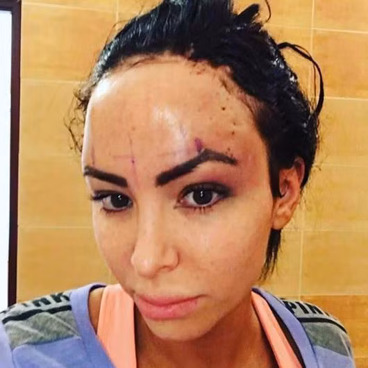 Trong hình là Star trong một lần phẫu thuật chỉnh sửa chán và cằm bởi cô cho rằng chúng trông quá nam tính. Ảnh: Thesun.