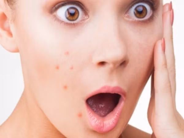 13. Trị mụn: Lá ổi giúp loại bỏ mụn trứng cá và các đốm đen từ da. Ảnh: Boldsky.