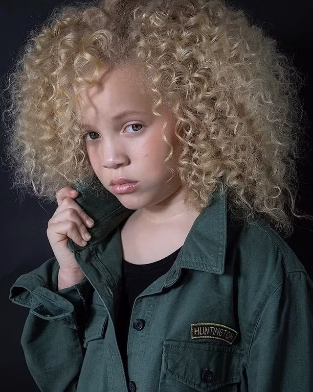 Albinism là hội chứng di truyền nổi tiếng làm người mắc bệnh bị điếc, giảm thị lực và nhiều biến chứng nguy hiểm khác. Tuy nhiên, những người mắc albinism thường có vẻ ngoài rất thu hút. Ảnh: BS.