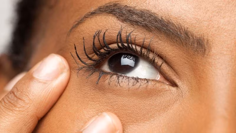 Vấn đề về mí mắt: Một số vấn đề về mí mắt hoặc lông mi cũng có thể làm khô mắt và sau đó làm cho họ chảy nước mắt. Mí mắt quay ngược ra bên ngoài (gọi là ectropion) hoặc hướng vào bên trong (gọi là entropion) có thể gây ra mắt nước. Nước mắt nhân tạo có thể giúp giảm thiểu sự khó chịu nhưng những vấn đề này thường đòi hỏi phẫu thuật. Ảnh: Getty.