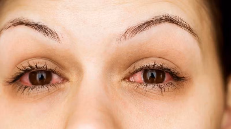 Bị viêm kết mạc hoặc mắt đỏ: Ngoài ra còn gọi là mắt hồng, viêm kết mạc thường gặp nhất do adenovirus, các vi khuẩn có thể gây ra cảm lạnh thông thường, viêm phế quản và đau họng. Viêm kết mạc khiến người bệnh bị chảy nhiều nước mắt. Ảnh: Getty.