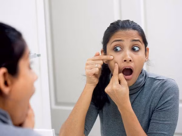 Mụn trứng cá: Một triệu chứng nổi bật của stress là nổi mụn trứng cá trên da; điều này là bởi vì các tế bào chịu trách nhiệm sản xuất sebum trộn với vi khuẩn da chết để tạo ra mụn nhọt. Stress có thể làm trầm trọng thêm sự xuất hiện của mụn trứng cá trên da của bạn. Ảnh: Boldsky.