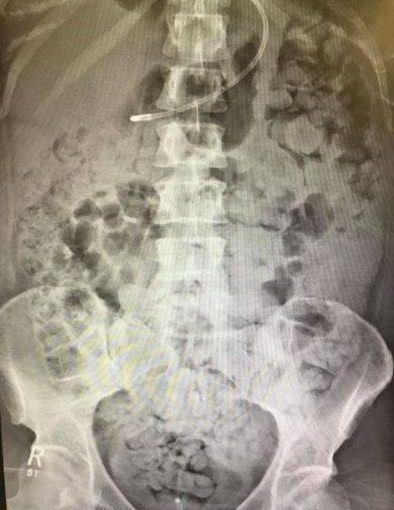 Ngực của Kelly Yeoman chứa đầy chất thải sau khi bác sĩ phẫu thuật làm hỏng ruột của cô. Ảnh: The Sun.